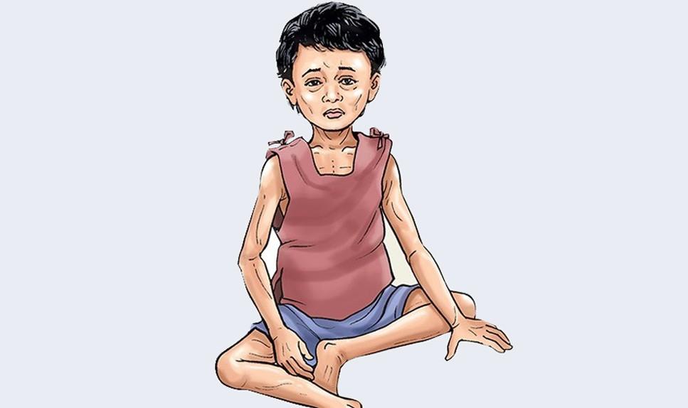 मधेसका १६ प्रतिशत बालबालिकामा कुपोषण